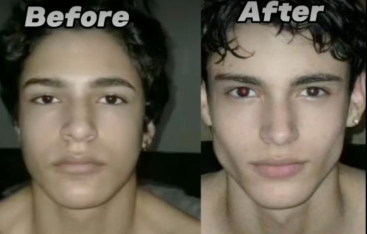 Before and After Jawline De-Bloat