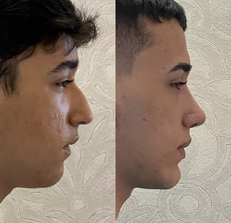 Real Nose Cartilage & Dorsal Bridge Transformation Result